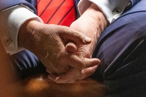 US President Donald Trump blames aspirin for bruises on his hand