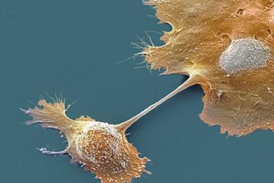 Pancreatic cancer has been notoriously difficult to treat.