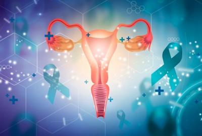 AI Proves Useful for Ovarian Cancer Diagnosis