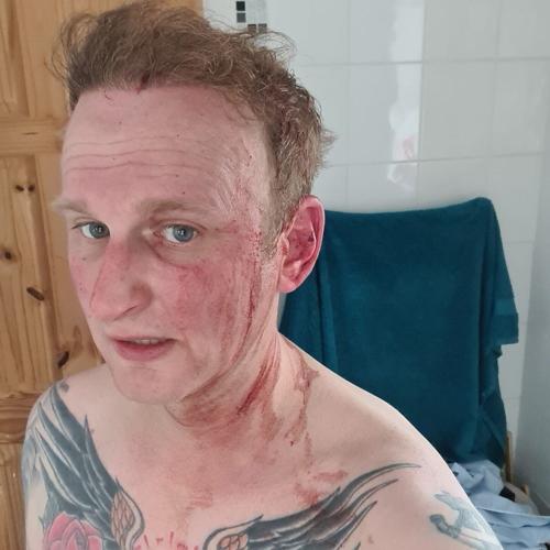 Jogger left covered in blood after being attacked by dive-bombing buzzard