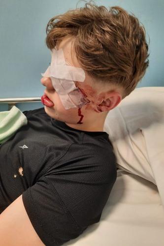 Teenager, 17, lost eye after ‘dud’ firework exploded in his face