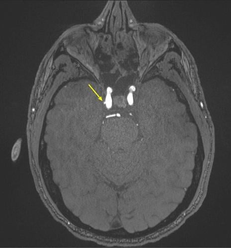 Special Forces more likely to suffer brain injuries due to exposure to explosions