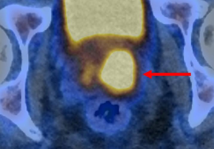 Scans that makes prostate cancer cells “glow” could cut need for invasive biopsies