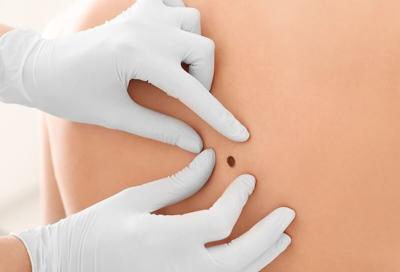 Blood Test Can Predict Melanoma Recurrence