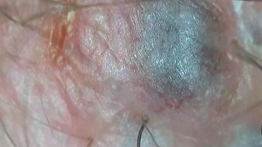 Mum says hairdresser “saved her life” – after they found cancer lump on her head