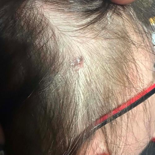 Mum says hairdresser “saved her life” – after they found cancer lump on her head