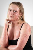 “My eczema cream left 95% of my body in agony – strangers think I’ve been burned”