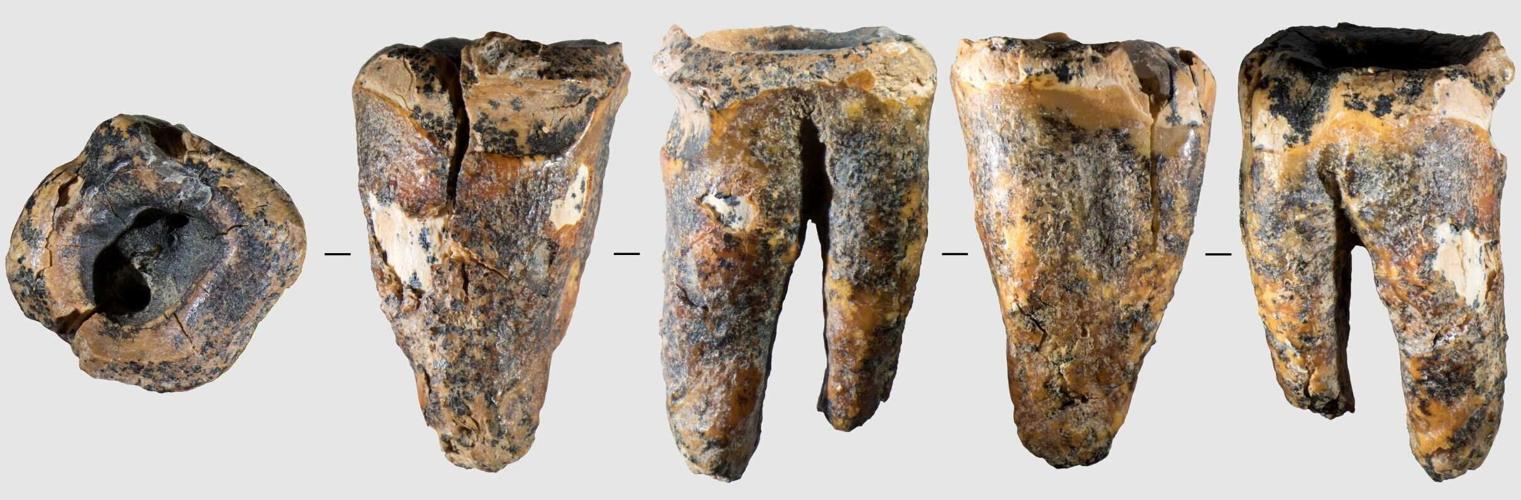 Tooth shows cavemen conducted dental surgery thousands of years before anaesthetic