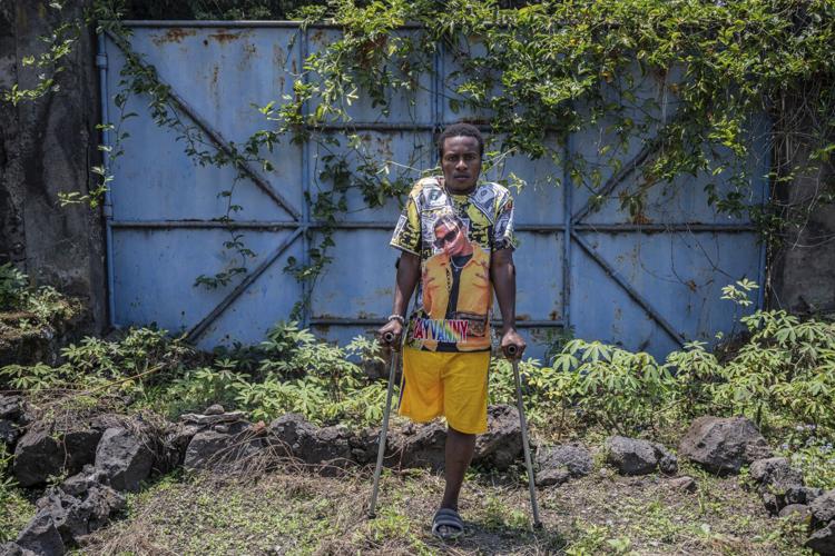 Photos of an orthopedic center in Congo that helps amputees regain