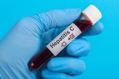 New 15-Minute Test For Hepatitis C Paves Way For Same-Day Treatment