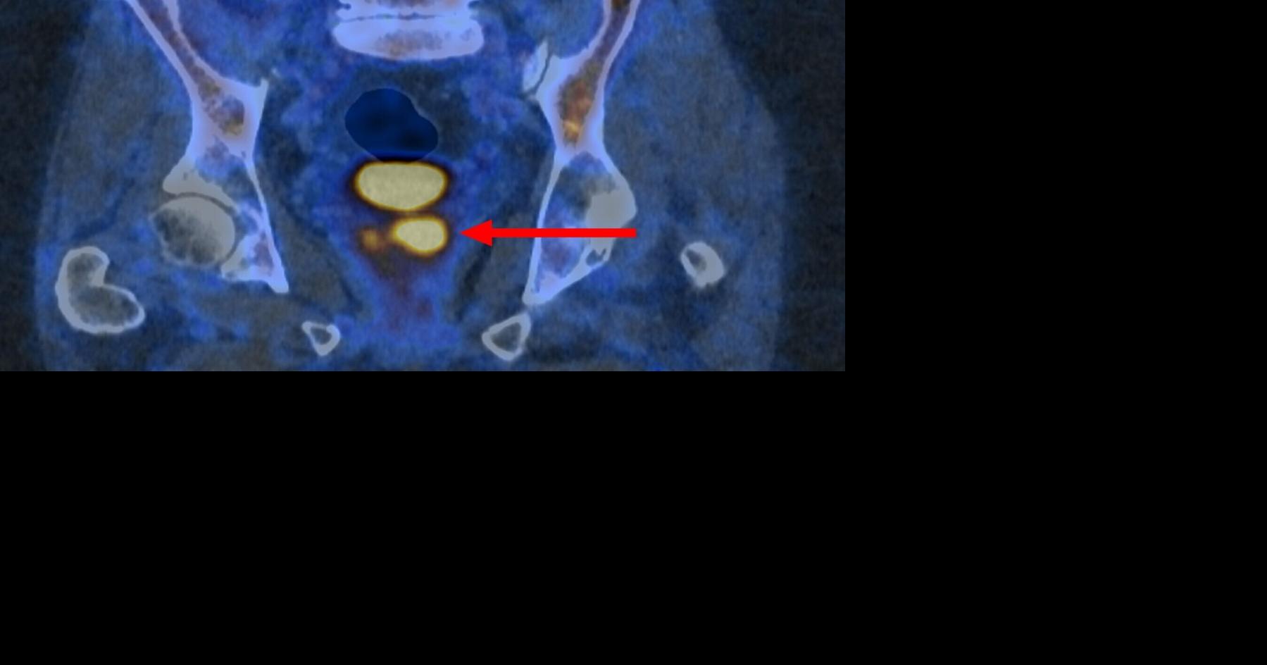 New state-of-the-art test identifies aggressive prostate cancer