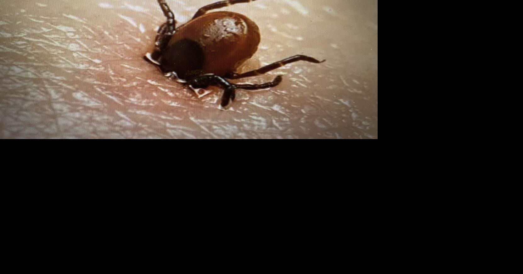 It's that time again: Tick, tick, boom! Don't let Lyme disease blow up your summer