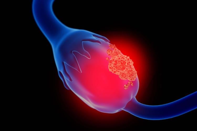 Landmark Study Led by Roswell Park Expert Shows Survival Benefit of Immunotherapy in Resistant Ovarian Cancer
