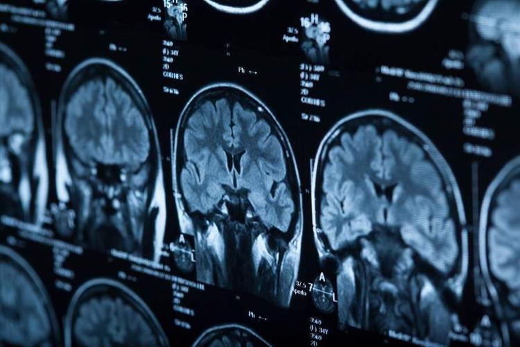 UB awarded $5 million to lead SUNY Brain Institute network on age-related brain disorders