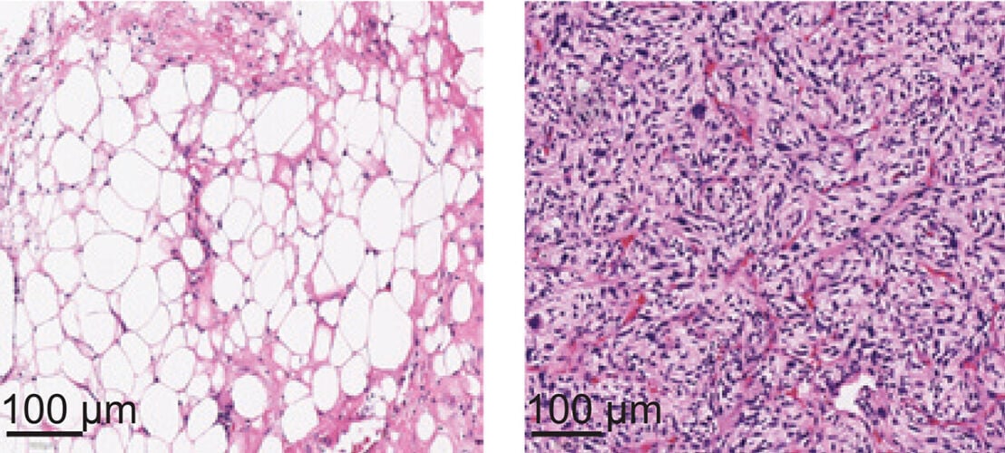 Protein ‘Switch’ Determines Whether Liposarcoma Cells Will Become Aggressive, Roswell Park Expert Reports