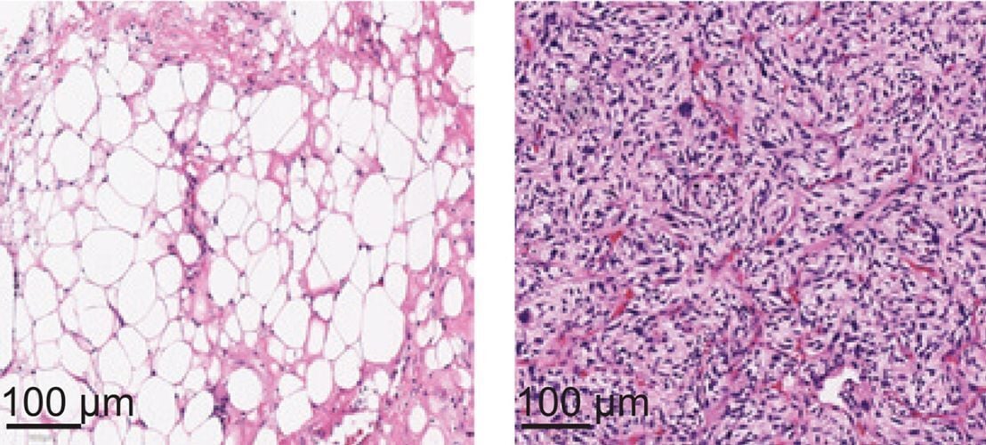 Protein ‘Switch’ Determines Whether Liposarcoma Cells Will Become Aggressive, Roswell Park Expert Reports