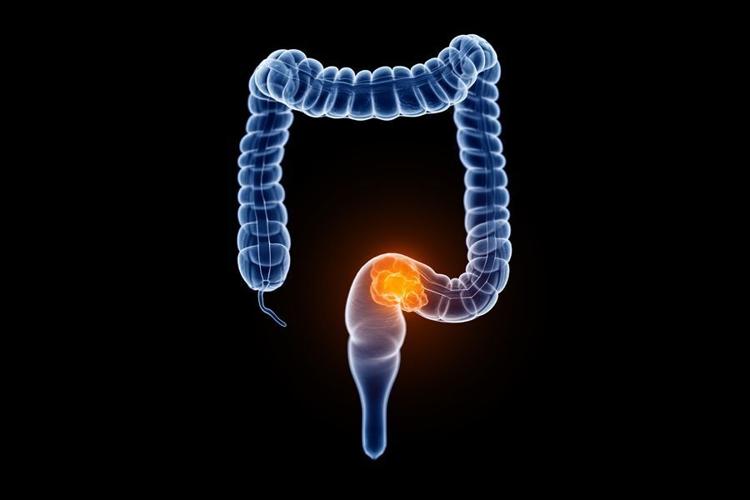 AACR 2026: Real-World Data Show Targeted Therapy Extends Survival in Aggressive Form of Colorectal Cancer