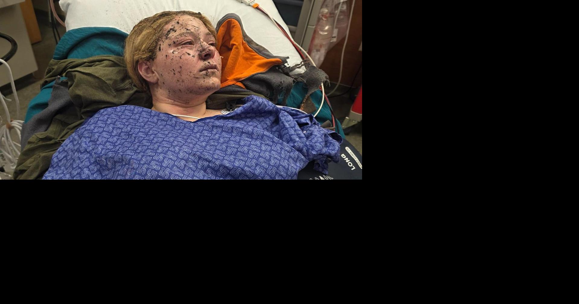 Logan restaurant worker severely burned in propane smoker explosion