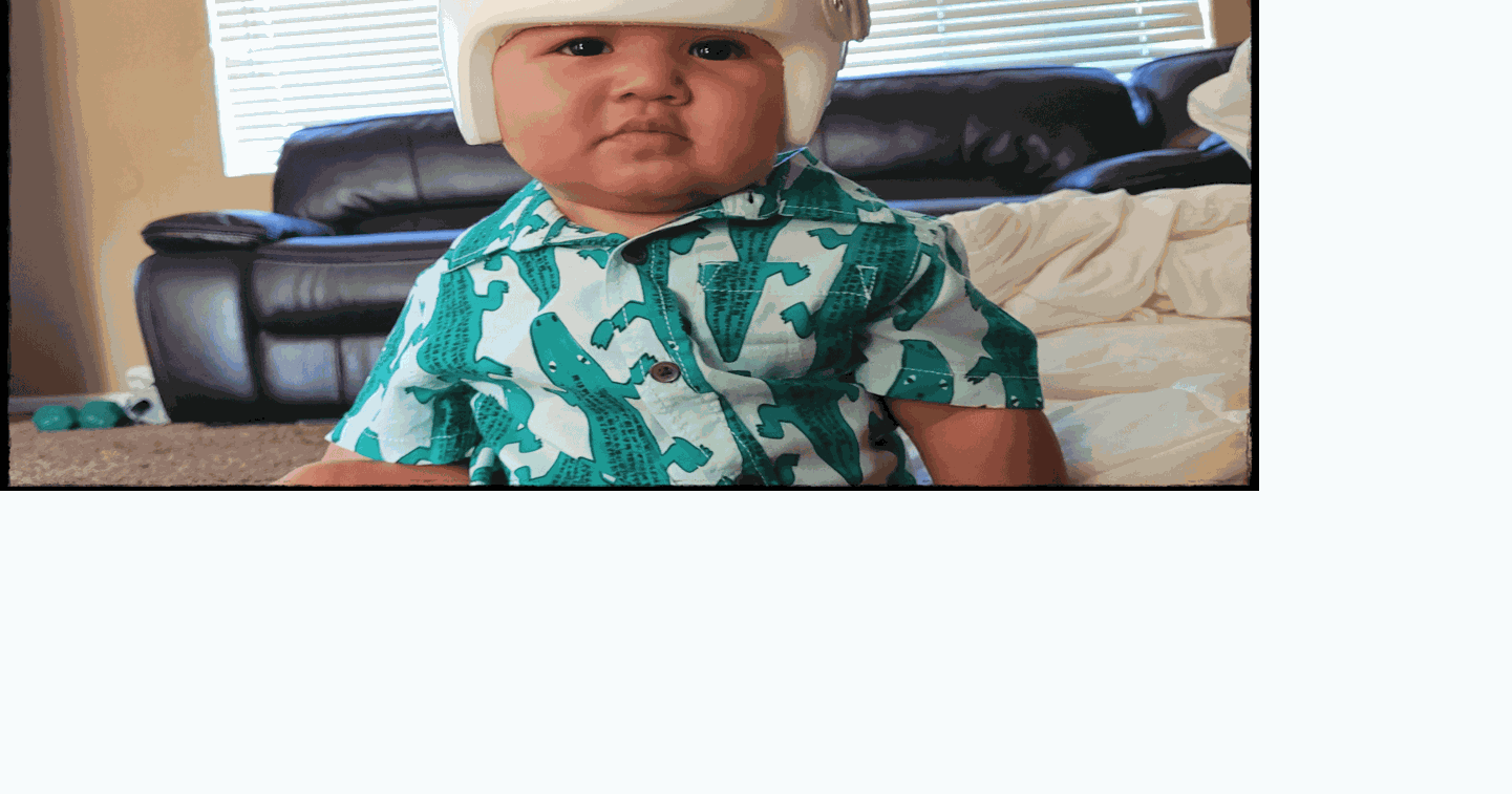 Mami M Buying your baby a cranial helmet may be necessary and