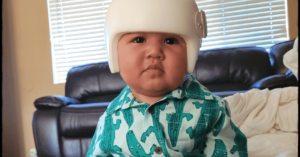 Mami & Mí: Buying your baby a cranial helmet may be necessary, and