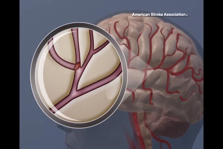 Clot in brain