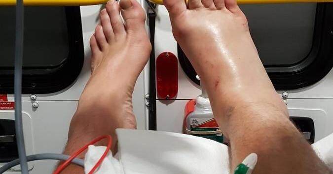 Cambridge man recovering from rattlesnake bite