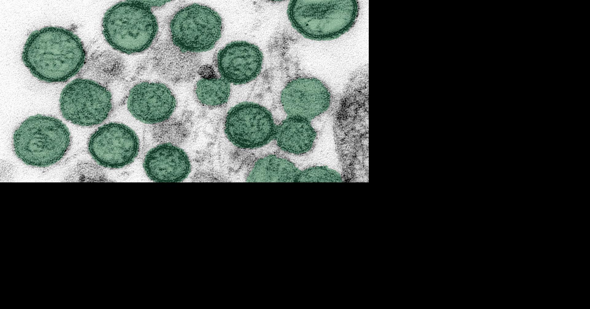 Hantavirus: What Madison experts want you to know
