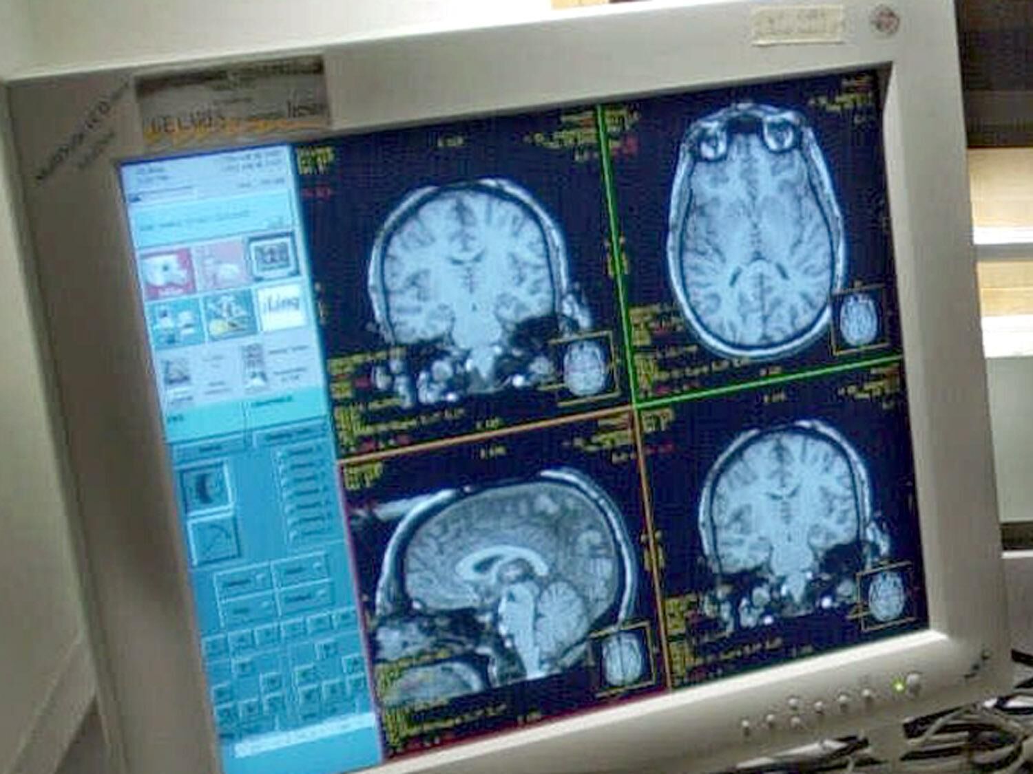 Researchers: Missing molecule could play big role in Down syndrome