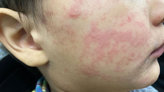 Measles case found at Union Hospital