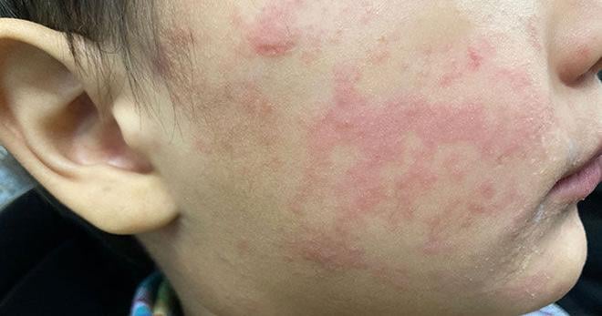 Second measles case found at Union Hospital
