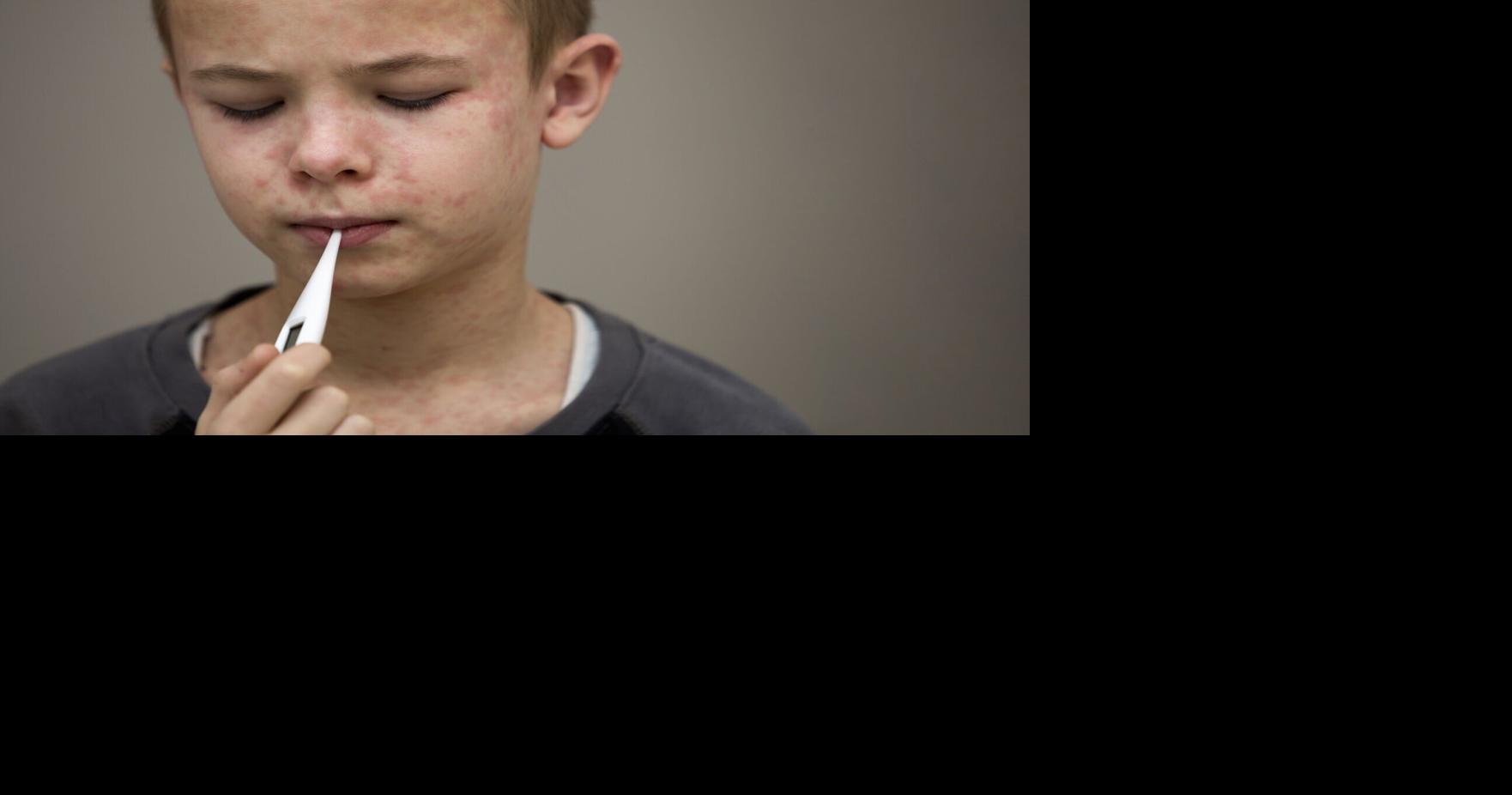 With over 100 measles cases in Southern Utah, anyone with symptoms should call ahead before seeking care