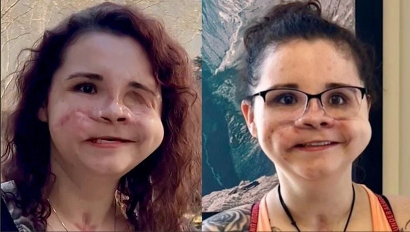 She survived being shot in the face as a teen. Then came ...