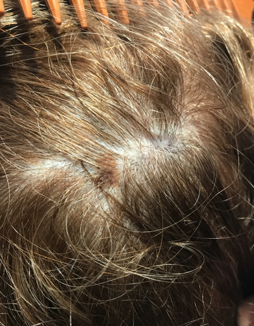 Melanoma On Scalp Pictures Early Stage Scalp Melanoma Images | My XXX ...