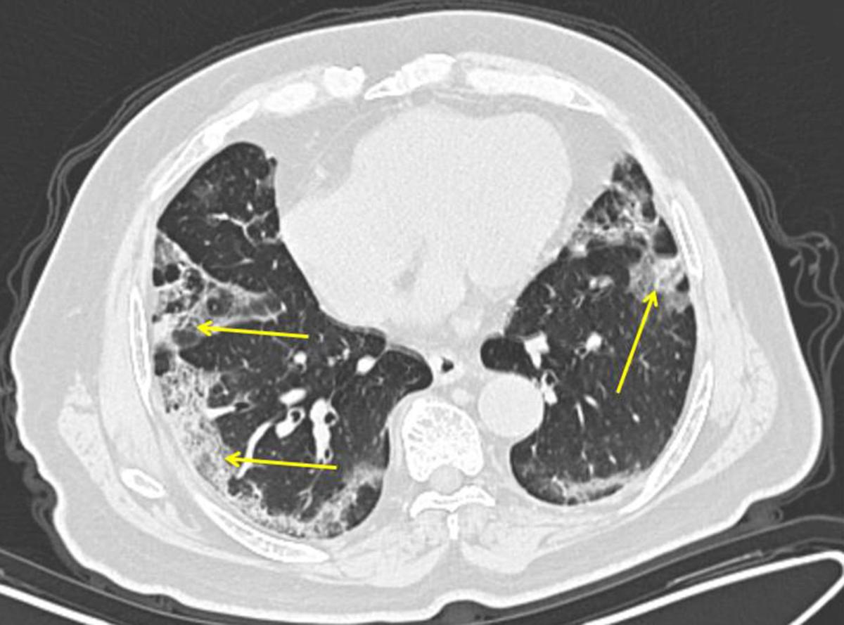 Covid 19 Lung Patterns Show Few Clues For Treating Pneumonia Live Well Cv Health And Wellness Cumberlink Com