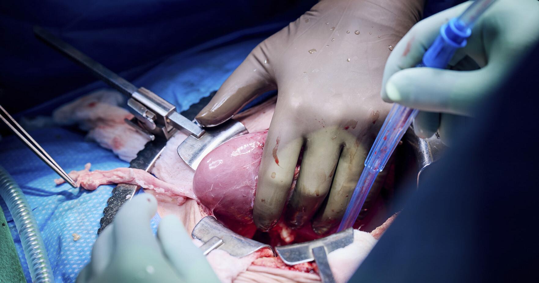 Advocates seek tax credit for kidney donors - Vimarsana News