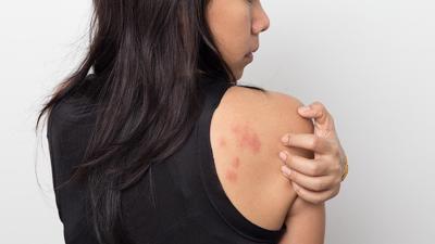 Got Hives? What You’re Itching to Know about Chronic Urticaria