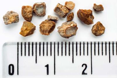 Doctors Discuss Kidney Stone Symptoms Treatment Options And Prevention News Dailyitem Com