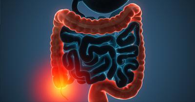 Colon Polyps Symptoms Polyps Symptoms Colon Cancer Awareness Polyps Colon