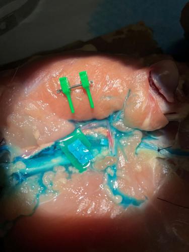 The view through a WiscVision Microscope. Blue dye injected through a catheter mimics blood, helping surgeons confirm their sutures won't leak.
