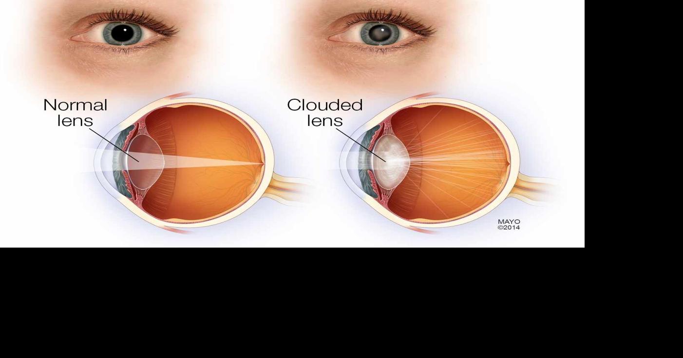 Faces looking blurry? Seeing halos at night? Could be cataracts ...
