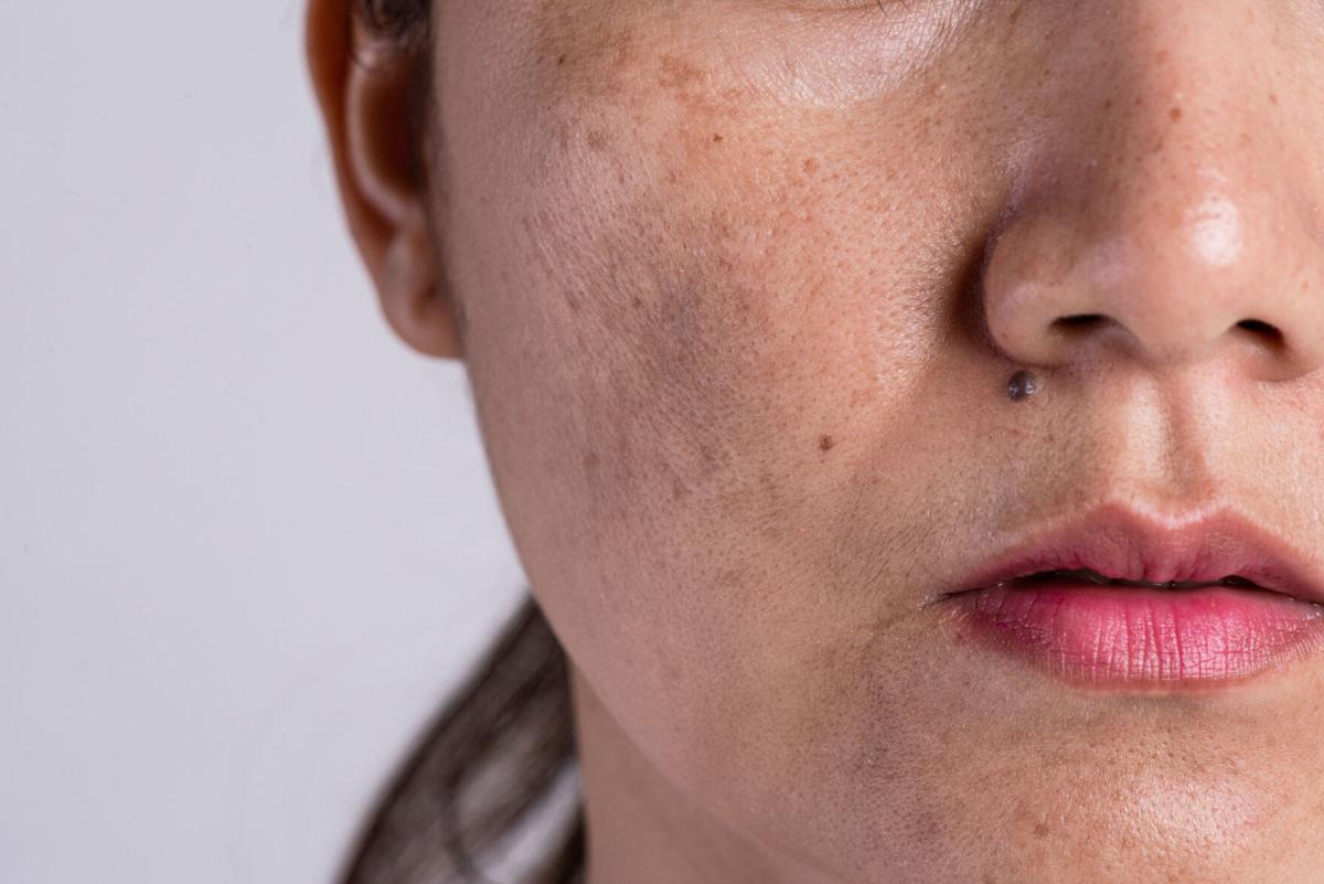 Melasma