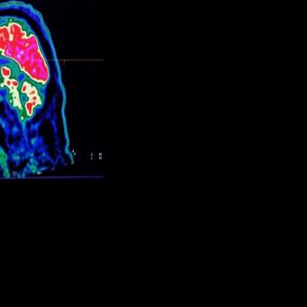 Final report casts doubt on existence of Canada mystery brain illness | National
