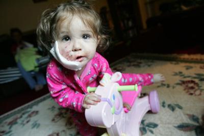dog bite to little girl s face requires
