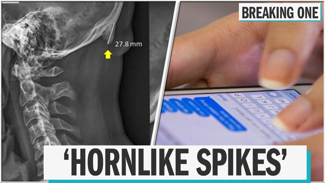 People are growing horns on the back of their skulls due to phone use