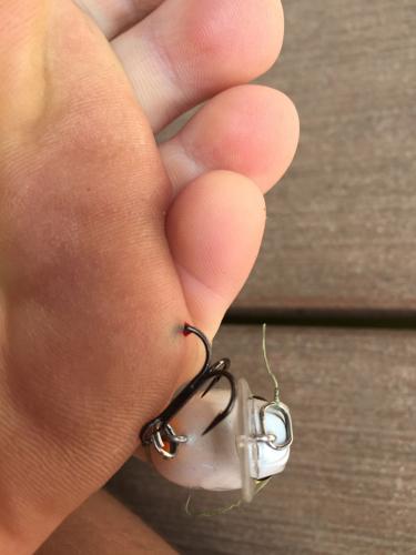 HOW TO REMOVE A TREBLE HOOK FROM FOOT 