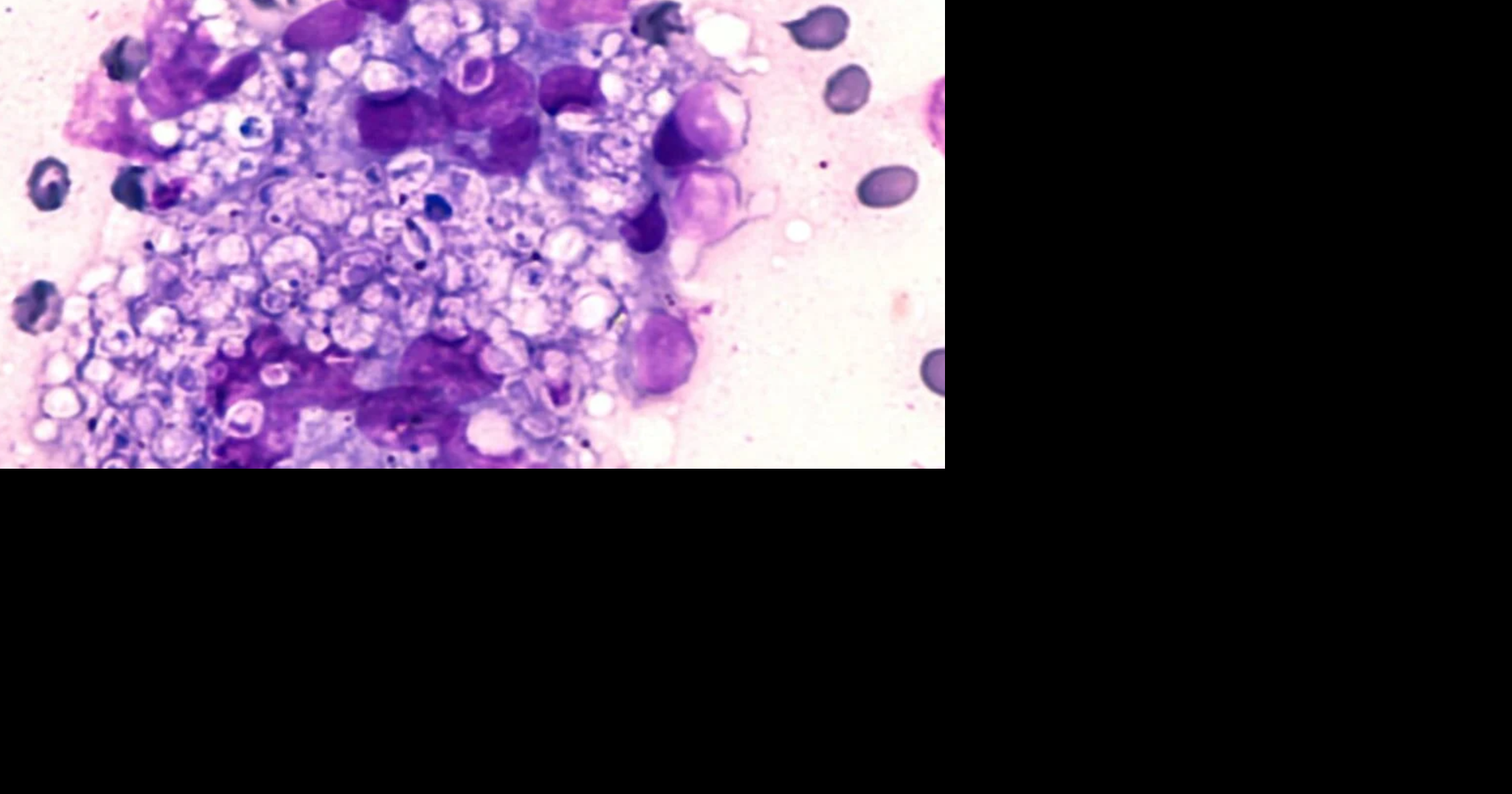 Deadly fungus outbreak in Middle Tennessee raises concerns about risk across the state