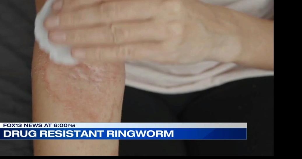 Mid-South should be on high alert for treatment-resistant ringworm ...