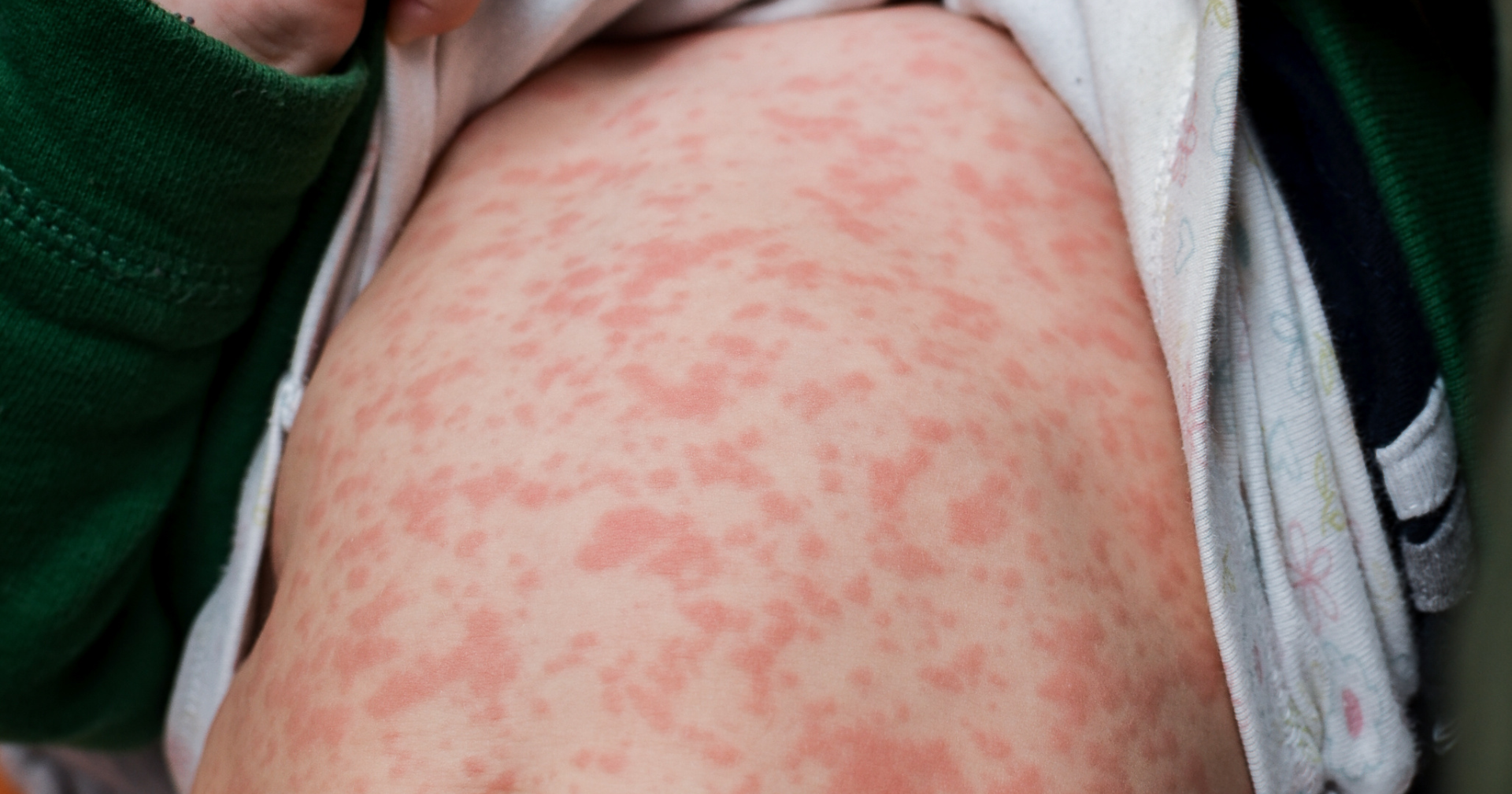 Doctors on high alert as measles cases pop up across country | News - Vimarsana News