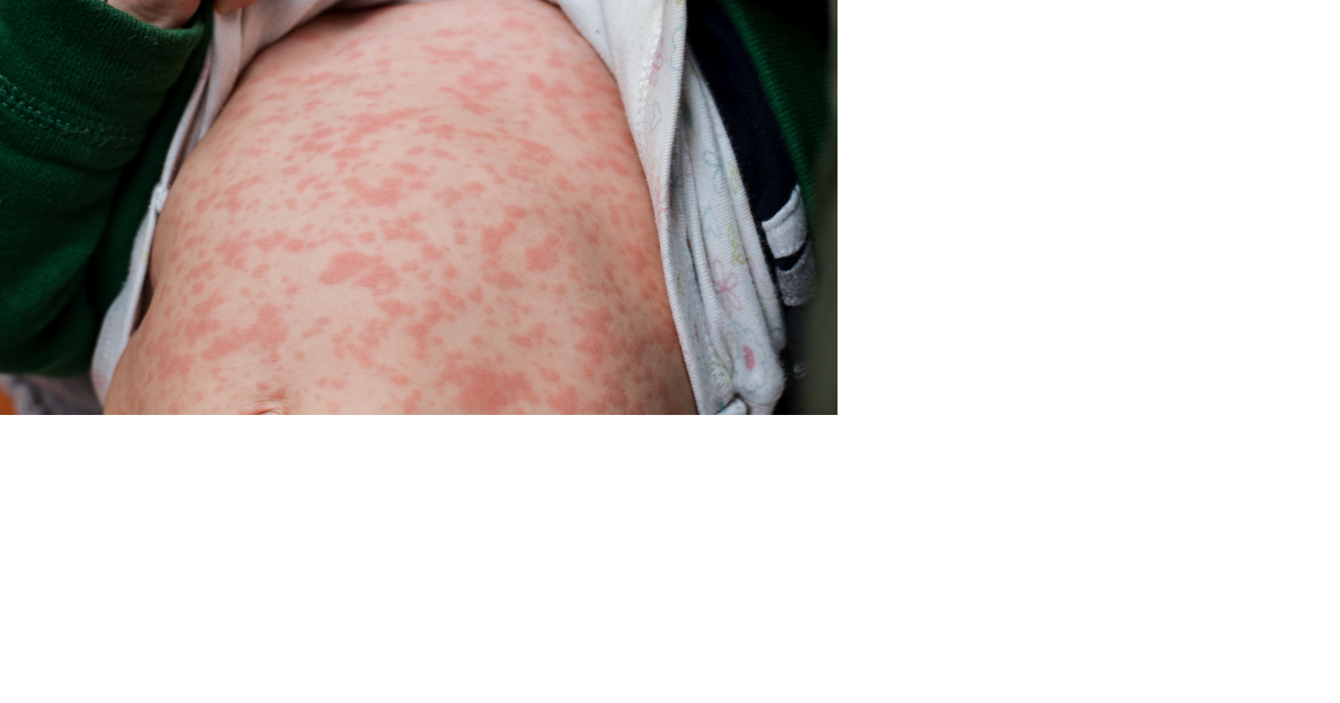 Doctors explain measles risks after confirmed case at Memphis airport