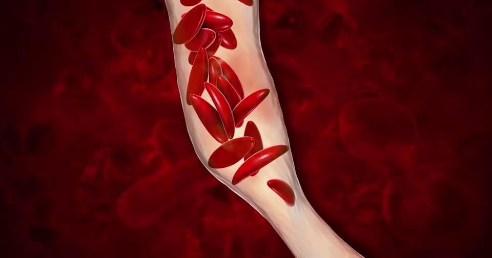 Memphis man with sickle cell disease defies odds after doctors feared he wouldn't survive 24 hours